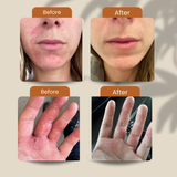 Koaka Skin Rescue Balm Before/After