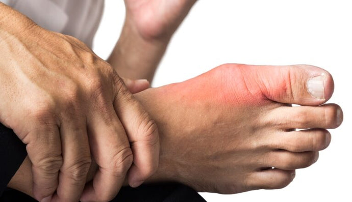 3 Symptoms & 3 Steps to Mitigate Gout