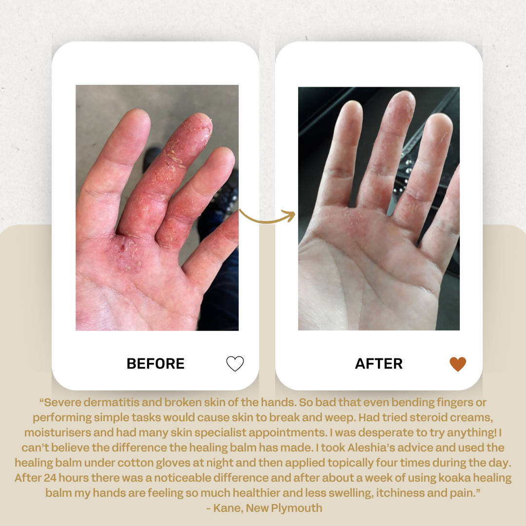 Koaka Skin Rescue Balm | Before/After Cracked Skin Hands