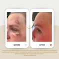 Load image into Gallery viewer, Koaka Skin Rescue Balm Before/After Burn
